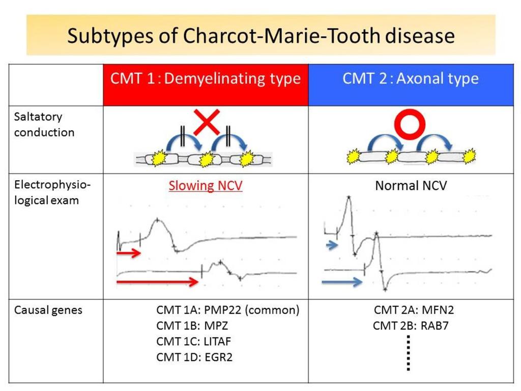 Fig. 2: Charcot-Marie-Tooth disease is electrophysiologically subdivided into demyelinating (CMT1) or axonal type (CMT2) by nerve conduction velocities (NCVs); CMT1 demonstrates severe diffuse motor