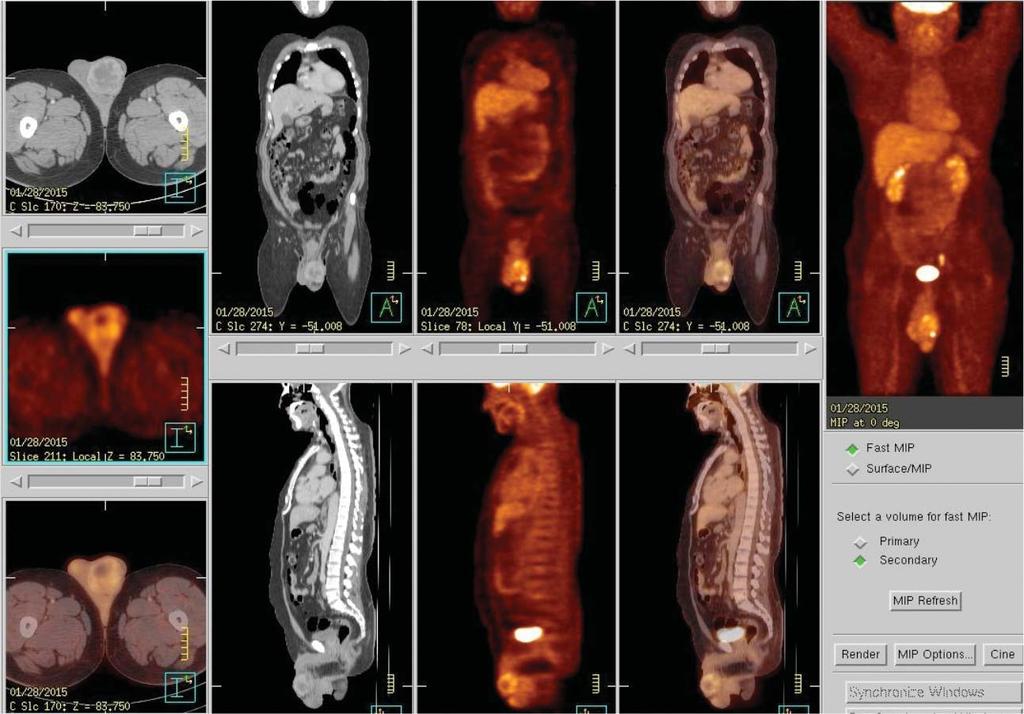 A Rare Case of Single, Isolated Liver Metastases from