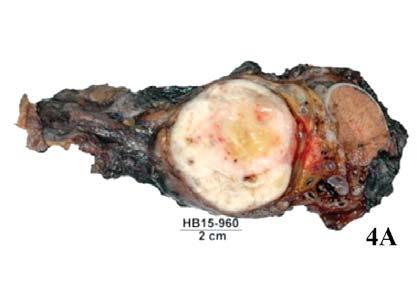 observed (Figure 4B ). Discussion Sarcomas are rare types of cancer that develop in the supporting or connective tissues of the body.