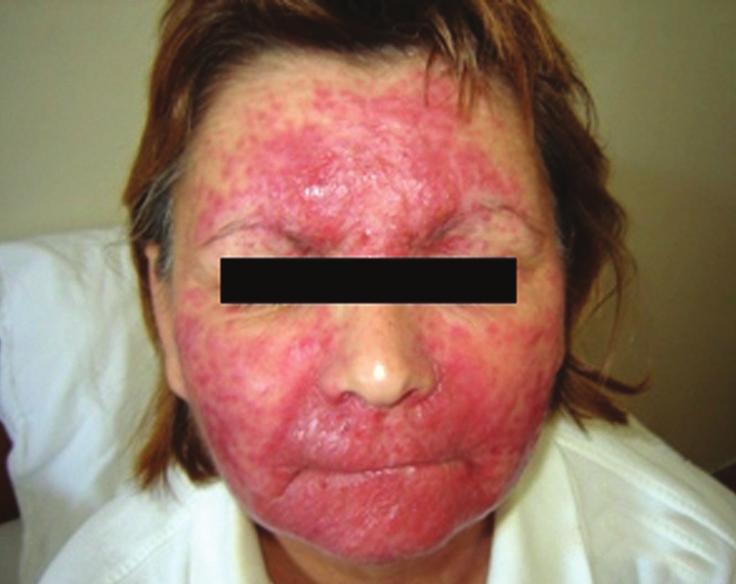 regresije svih simptoma bolesti, a bolesnica je na kožu lica nastavila primjenjivati samo topičke indiferentne pripravke (slika 2).
