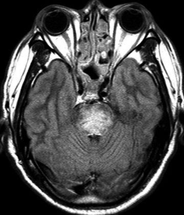 Contrast-enhanced T1- weighted images showed focal parenchymal enhancement involving the right gyrus rectus and subtle subependymal enhancement along both