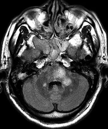 Another follow-up MRI, obtained 10 days later, after persistent A B C D E F Fig. 1. Magnetic resonance imaging in a 57-year-old man with general weakness, gait disturbance, and altered mental status.