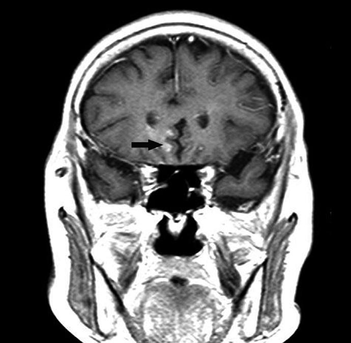 Uncommon Manifestations of Scrub Typhus Encephalitis in Two Cases medical therapy, showed that the subependymal enhancement along both the lateral ventricles had disappeared and new multifocal T2