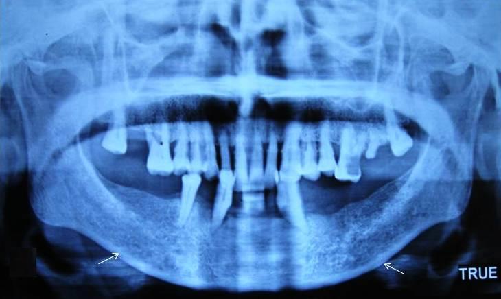 All the panoramic radiographs (OPG) were evaluated by 5 different oral radiology specialists.
