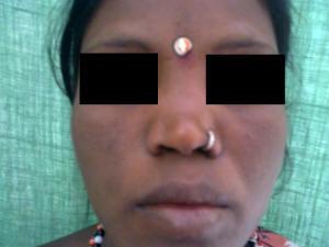 World Articles of Ear, Nose and Throat ---------------------Page 9 Patient 3: A patient of Lepromatous Leprosy (LL) with Saddle nose deformity. The patient also had a complaint of Stuffiness.