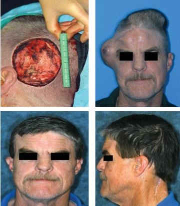 Sokoya et al. 93 Free Tissue Transfer Free tissue transfers are typically reserved for very large defects, previously radiated patients, exposed cranial contents, or chronic infection.