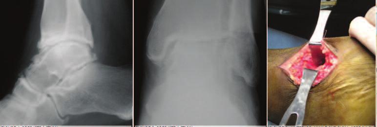 C A S E S T U D Y 1 ANKLE DISTRACTION WITH ARTHROPLASTY AS AN ALTERNATIVE TREATMENT FOR SEVERE ANKLE ARTHRITIS Introduction A retrospective review was performed to determine the feasibility of