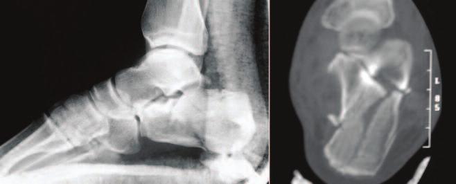 C A S E S T U D Y 2 RETROSPECTIVE COMPARATIVE ANALYSIS OF INTRA-ARTICULAR CALCANEAL FRACTURES Introduction The purpose of this study was to compare outcomes following the treatment of intra-articular