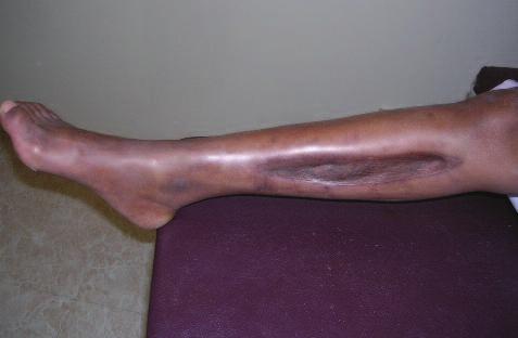 patient was placed in an ankle foot orthosis.