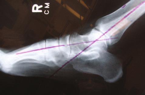 GRADUAL CORRECTION OF SUBLUXED ANKLE EQUINUS UTILIZING EXTERNAL FIXATOR FOLLOWED BY RETROGRADE INTRAMEDULLARY NAIL
