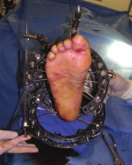 She developed a drop foot due to damage to the anterior muscle group of her right extremity.