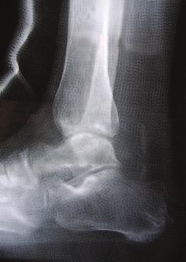 At six weeks, the patient was brought to the operating room for removal of the External Fixator and intramedullary retrograde nail was inserted