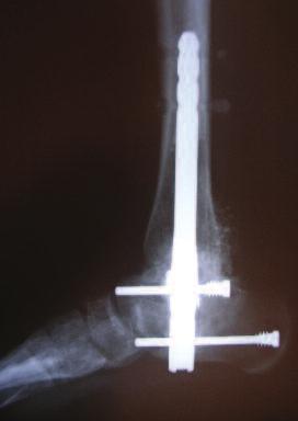 Postoperative The patient remained pain-free and non-weight bearing for a period of two weeks in a short leg cast followed by an additional 10