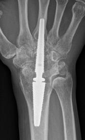 A custom made titanium alloy peg was constructed to enable arthrodesis with the original arthroplasty components in