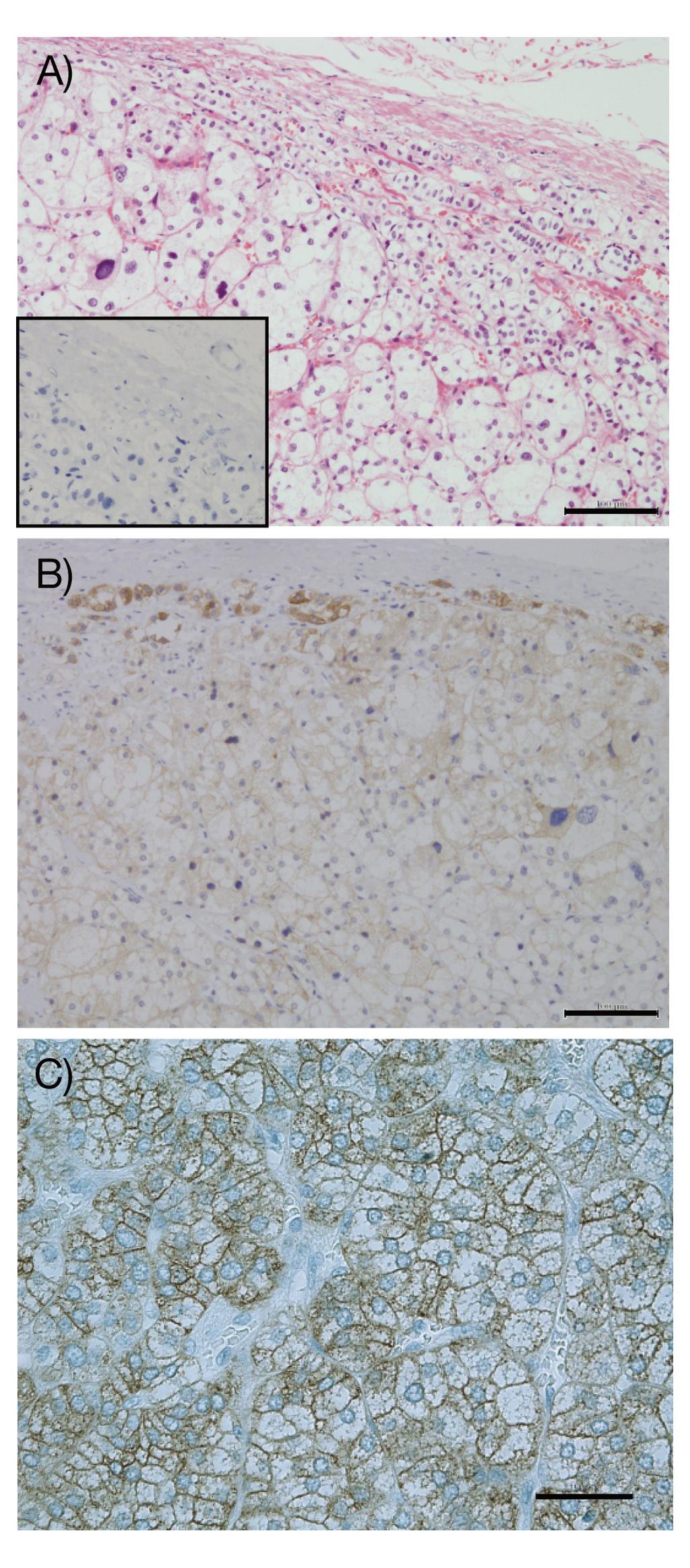 44 Okamura et al. Immunohistochemistry for KCNJ5 in APAs Fig. 3A and 3B show the results of staining with hematoxylin-eosin and an antibody against KCNJ5 in a normal adrenal gland adjusted to an APA.