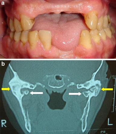 40 Oral Maxillofac Surg (2014) 18:39 42 asymptomatic disease. Imaging diagnosis is essential in differentiating and in evaluating of the degree of ankylosis.