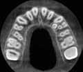 Implantology, Impactions Other cases