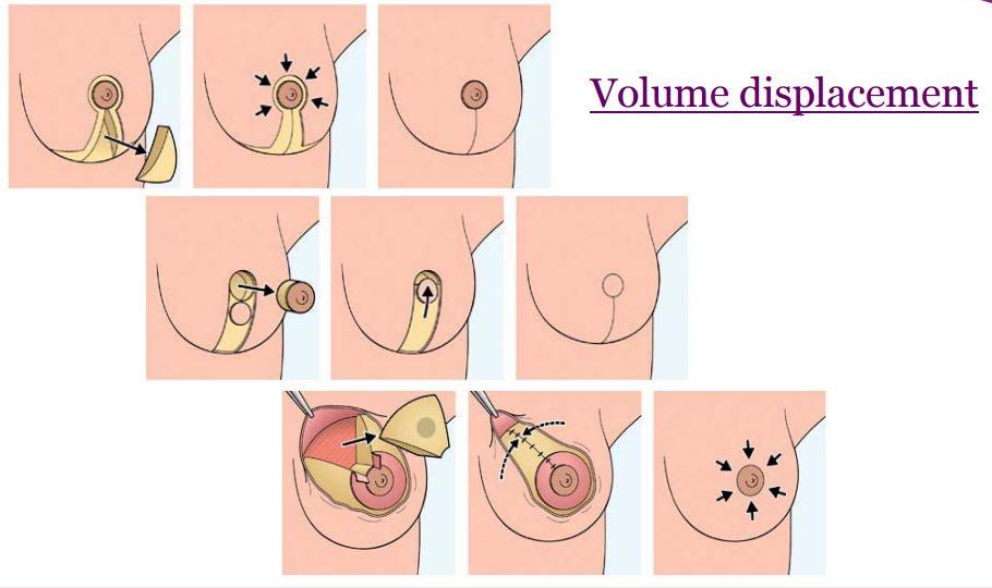 ONCOPLASTIC TECHNIQUES Breast conservative surgery Volume