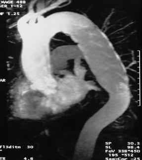 Aortic Dissection pre