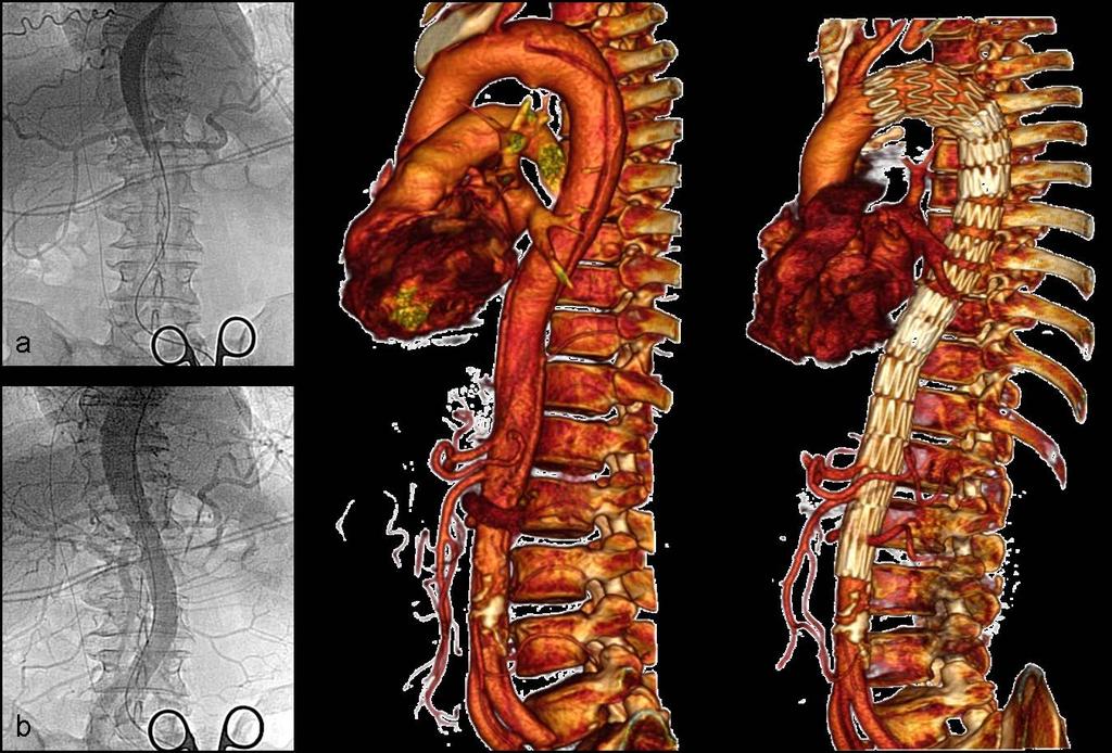 High risk group: Complicated type B dissection Malperfusion syndrome treated with endovascular