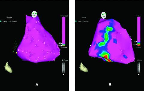 ENDOMYOCARDIAL BIOPSY guided by Voltage Mapping in ARVC