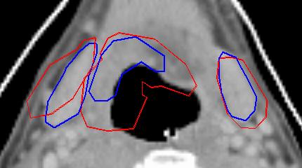 Sub-mandibular Glands Just after radiotherapy Parotid Glands