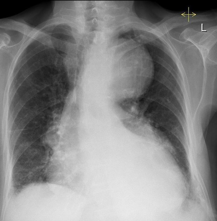 Known case of hypertension presenting with chest pain. What is the arrow pointing at?