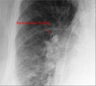 pulmonary edema CASE: 70 year-old female with orthopnea. What is abnormal in the x-ray? Pulmonary edema (cardiogenic).