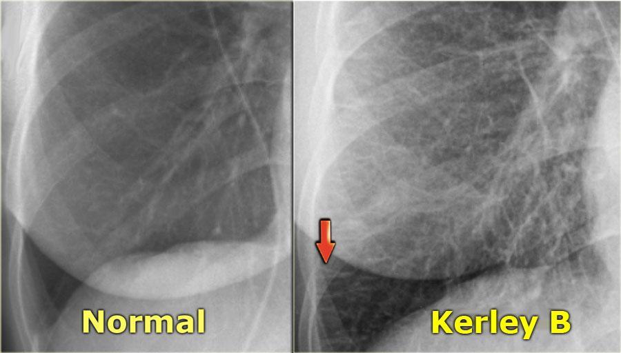 Signs of pulmonary edema on chest x-ray: Upper lobe pulmonary venous diversion. Fluid usually accumulate down due to: 1- gravity, 2- the lower lobes are bigger.
