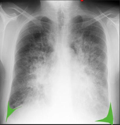(blue shape) It explained why we said it is cardiogenic pulmonary edema. Features of pulmonary interstitial edema: a) Peri-bronchial cuffing.