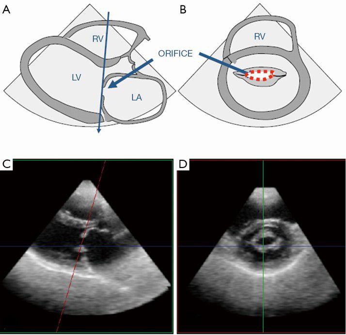 echocardiography Check slide 9 Aortic valve stenosis