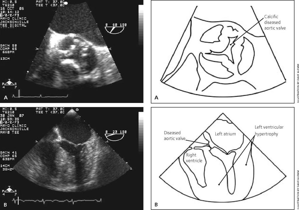 Interatrial Septal defect Opening between the 2 atria