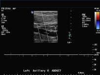 aggressively treated Routine venography following FRRS at 2 weeks is indicated in patients