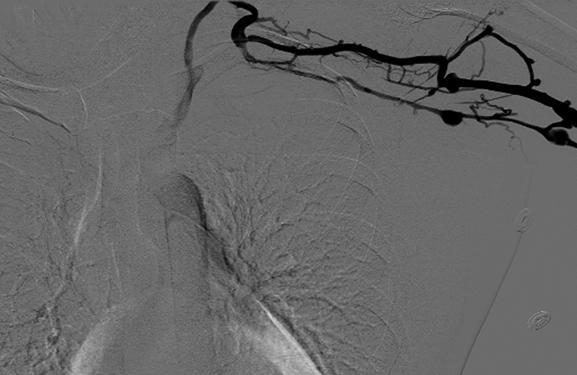 Venogram of an Occluded Vein Duplex Scan: Recanalization of an Occluded Vein