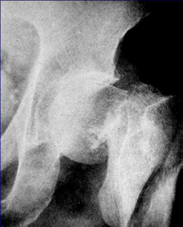 Family history of hip fracture is a strong risk factor for hip fracture Guess our risk of hip fracture 2-fold