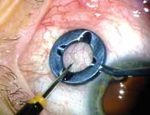 C D E F Figure 4. Use of the DEP to stabilize the eye and displace the conjunctiva ().