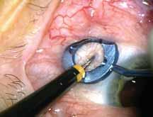 ngled entry into the globe (C). Use of semi-circular indentations to free the microcannula from the trocar (D).