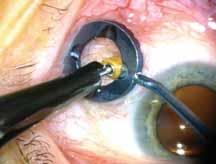 ll three microcannulas in place prior to vitrectomy (F). conjunctiva without displacement.