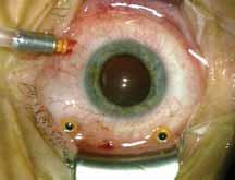 associated with small blebs. Gupta et al 22 reported hypotony within the first 24-hour period in numerous eyes as well.