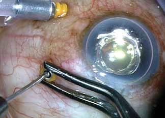 C D Figure 5. The light pipe is inserted through the microcannula prior to removal to prevent vitreous wick prolapse ().