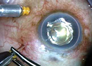 Once the microcannula is removed, the light pipe is safely removed, and no discernible bleb or sign of extrusion is noted (C).