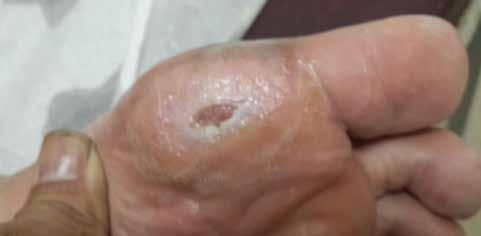The current foot ulcer with corresponding swelling had been present for the past twelve (12) months.