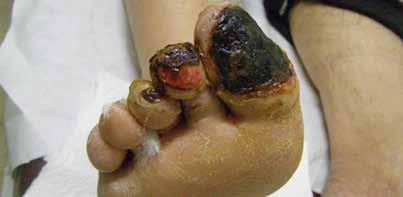 CASE 2: TYPE-II DIABETIC FOOT ULCER WITH INFECTION DIABETIC FOOT ULCER WITH INFECTION OF