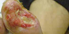 The wound was infected across three toes on the right foot for over twelve (12) months. Mr. O.