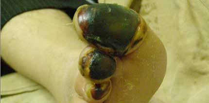 Although the infection level reduced significantly, the toes were still infected and the size of the wound remained the same (Image #3).