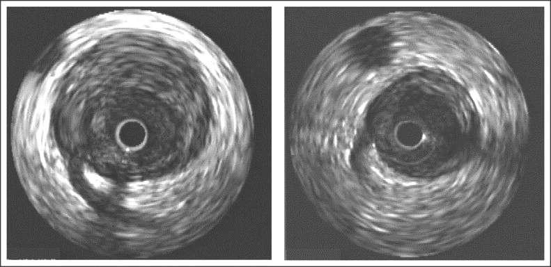 IVUS images of the same cross section of coronary artery at baseline (left) and follow-up (right).
