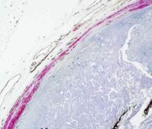 Erosion Stable Thin cap atheroma