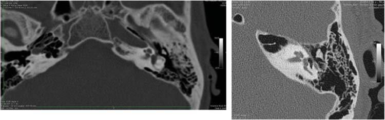 Axial CT and XperCT reformation images of a patient admitted after a facial trauma (Lefort III fracture) were obtained from the initial full head acquisition to rule out a committed fracture of the