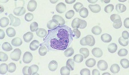 The Blood Film and Count 11 Fig. 1.11 A monocyte, showing a lobulated nucleus and voluminous, opaque cytoplasm containing very fine azurophilic granules. Several platelets are also visible.