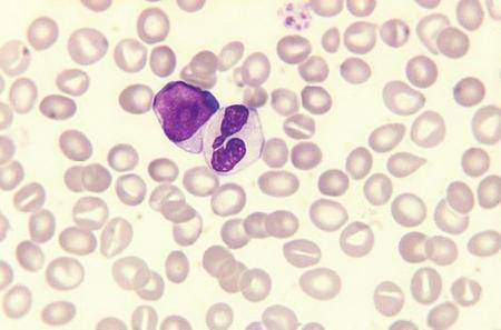 The Blood Film and Count 13 Fig. 1.13 A blood film of a patient with a myelodysplastic syndrome showing a myeloblast and a neutrophil.